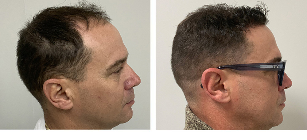 hair transplant before and after