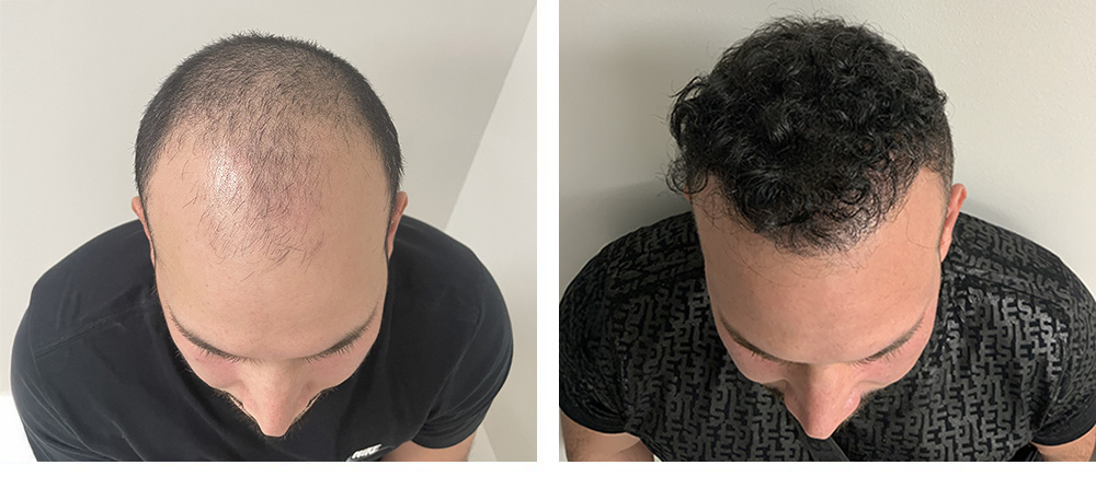 Hair Restoration Results Before and After