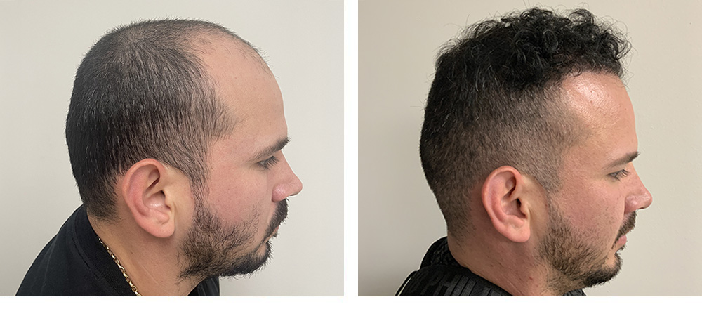 Hair Restoration Results Before and After
