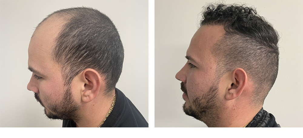 Hair Restoration Results Before and After