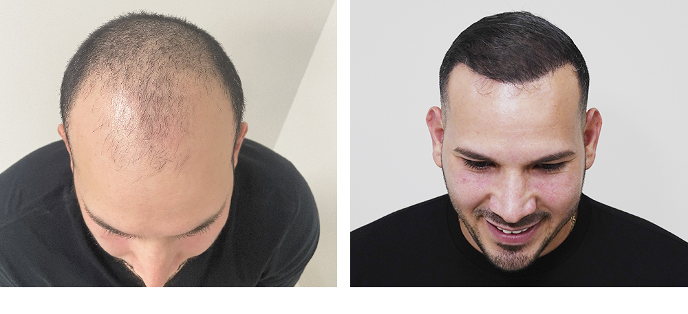 Hair Restoration Results Before and After