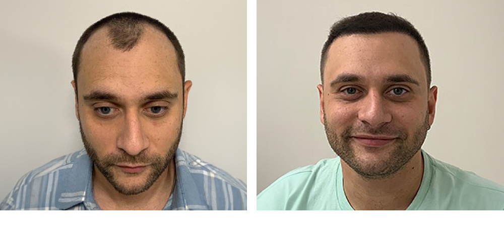 Hair Restoration Results Before and After
