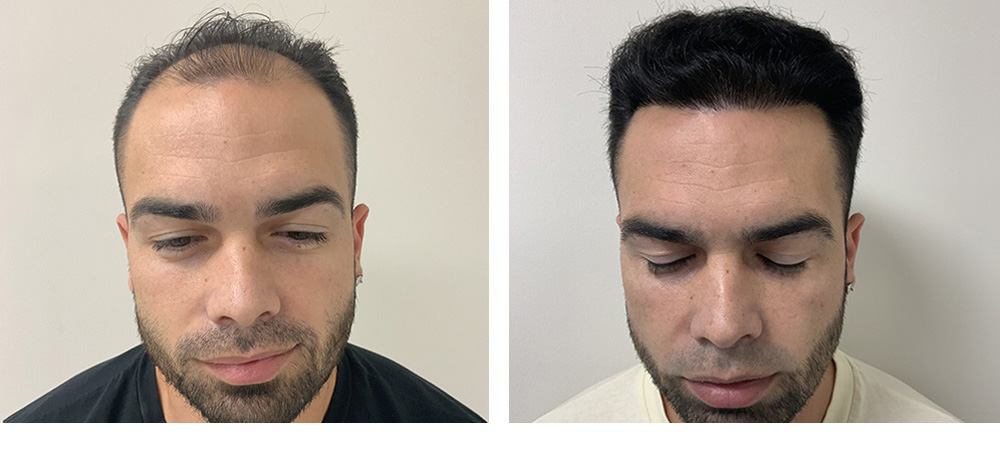 hair transplant before and after in miami