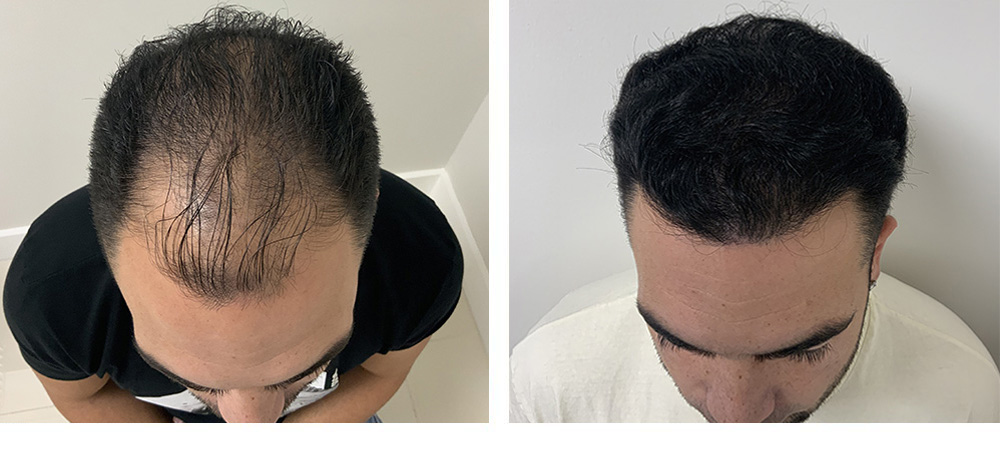 hair transplant before and after in miami