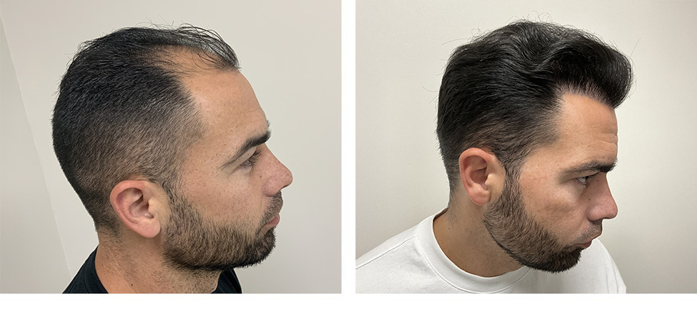 hair transplant before and after in miami