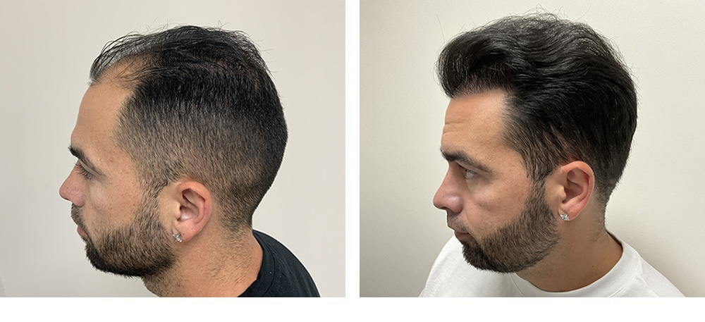 hair transplant before and after in miami