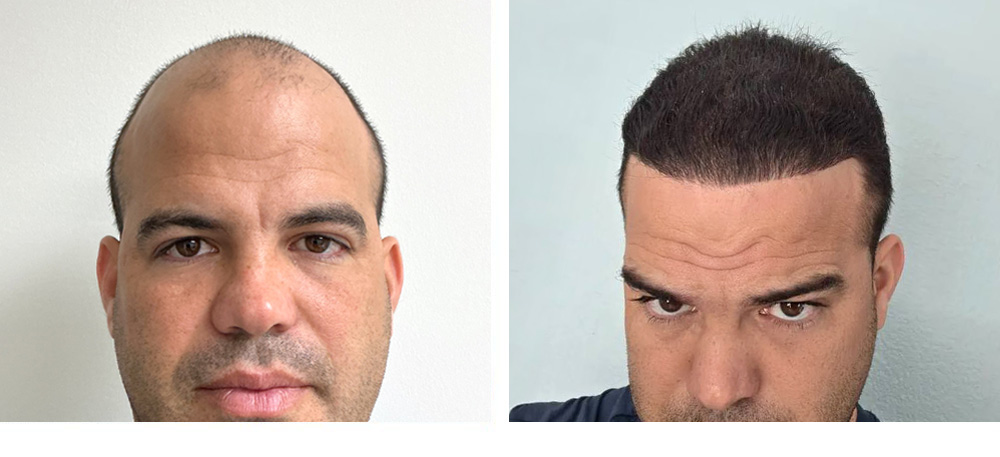 Hair Transplant Before and After