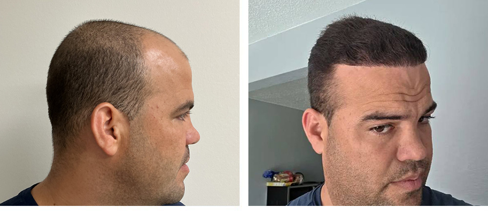 Hair Transplant Before and After