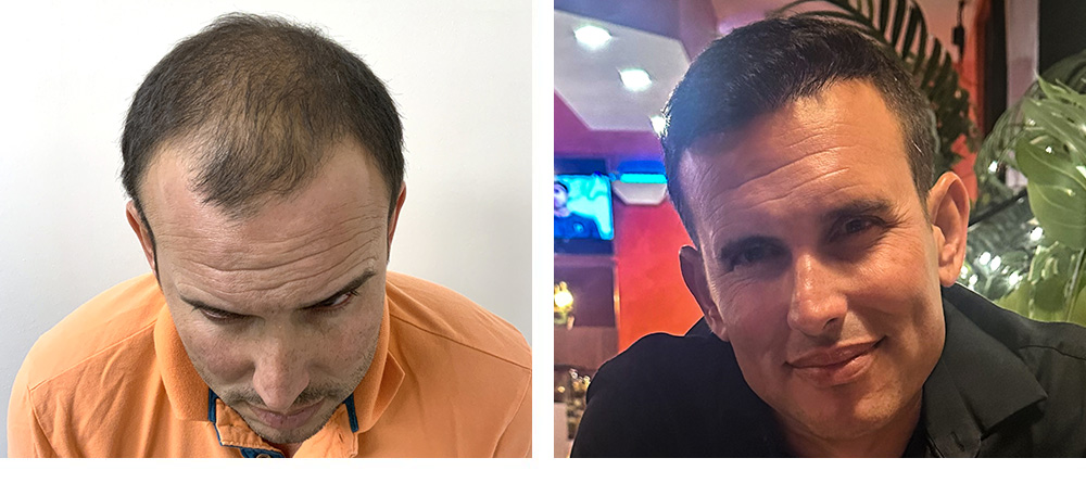 Hair Transplant Before and After