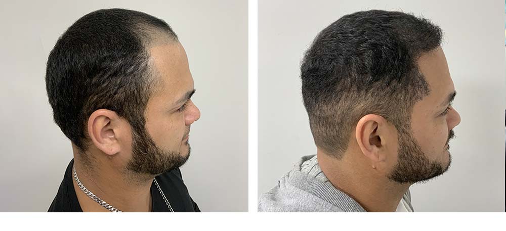 Hair Restoration Results Before and After