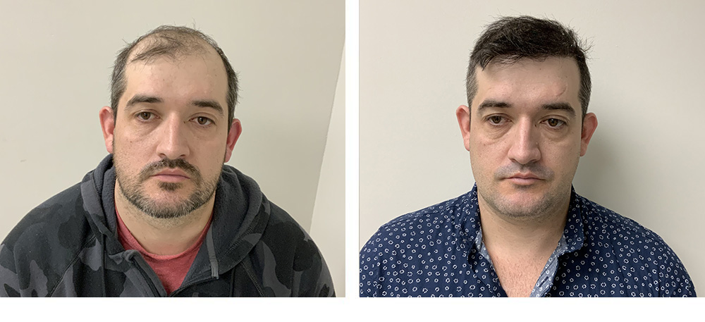 Hair Transplant Before and After