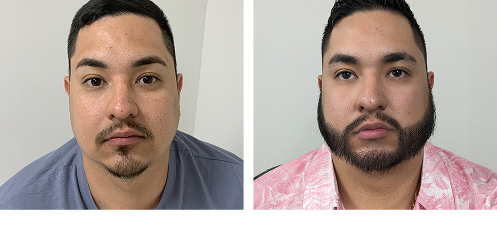Hair Restoration Results Before and After