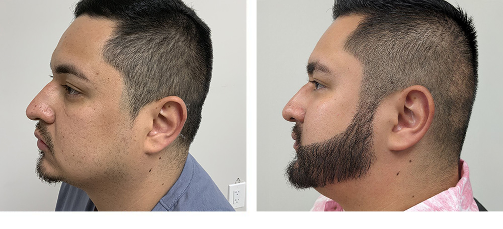 Hair Restoration Results Before and After