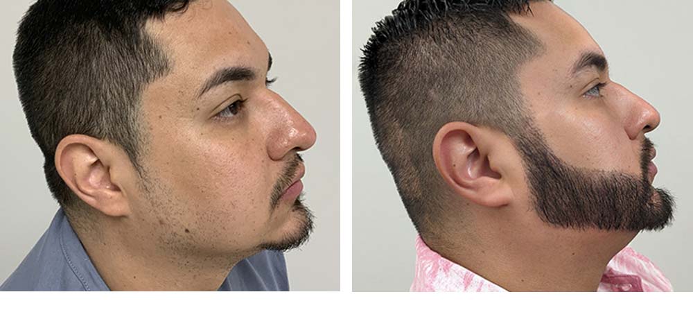 Hair Restoration Results Before and After