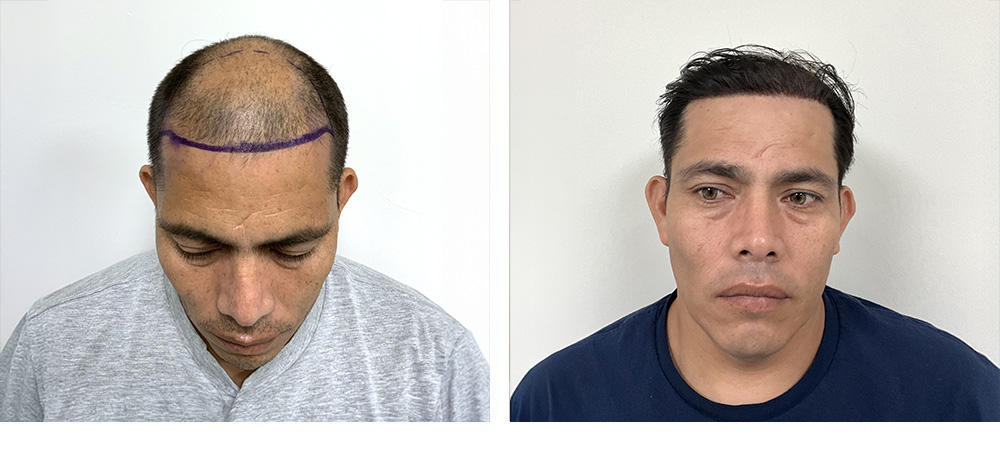 Hair Transplant before and after