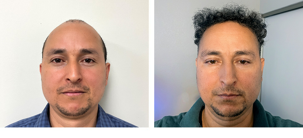 Hair Transplant Before and After
