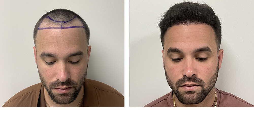 Hair Restoration Results Before and After