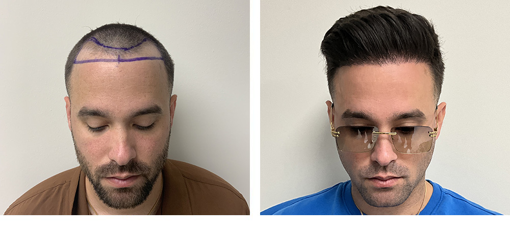 Hair Restoration Results Before and After