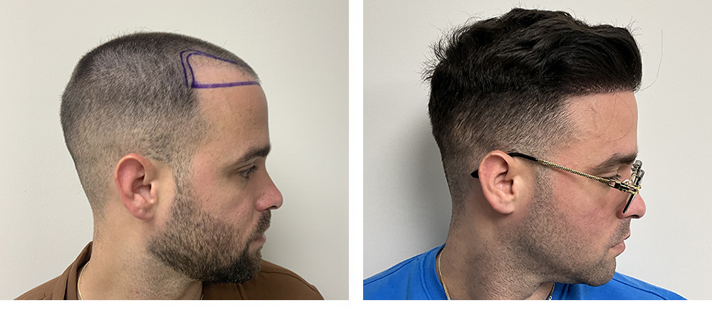 Hair Restoration Results Before and After