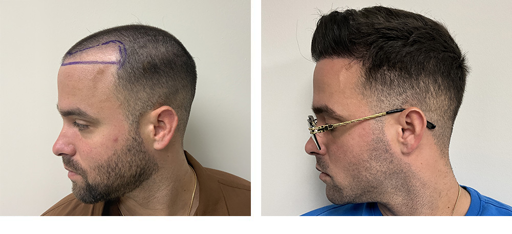 Hair Restoration Results Before and After