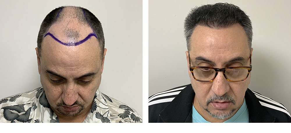 Hair Restoration Results Before and After