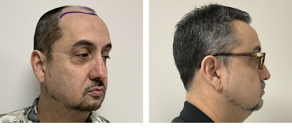 Hair Restoration Results Before and After