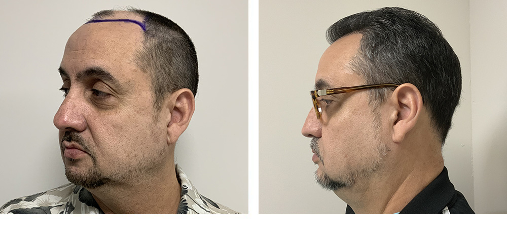Hair Restoration Results Before and After
