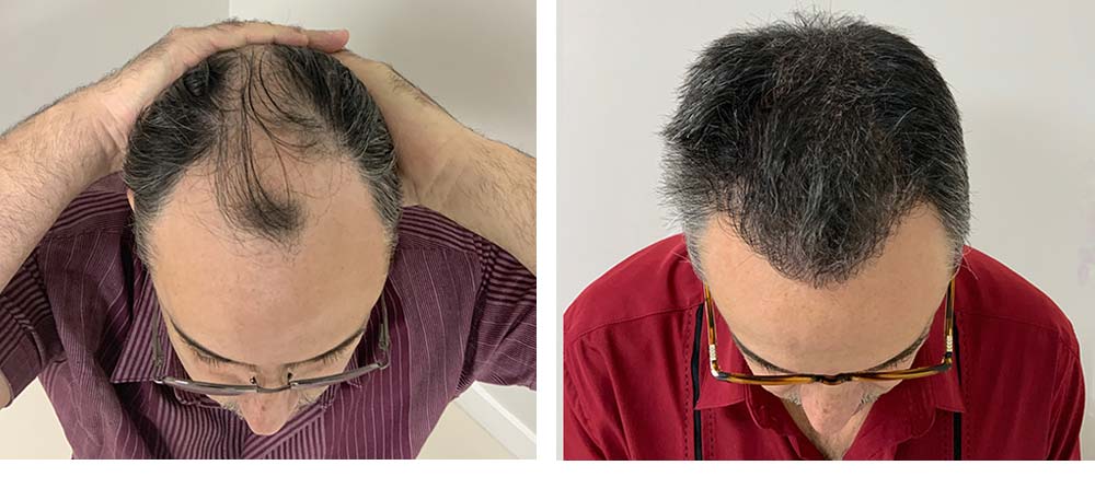Hair Restoration Results Before and After