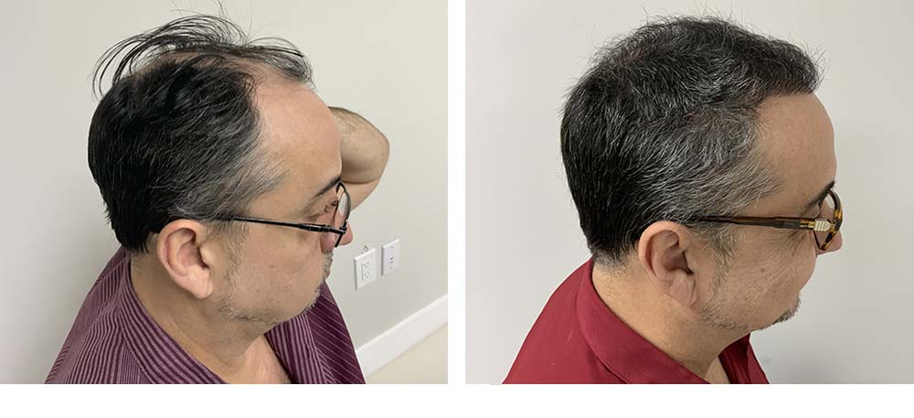 Hair Restoration Results Before and After