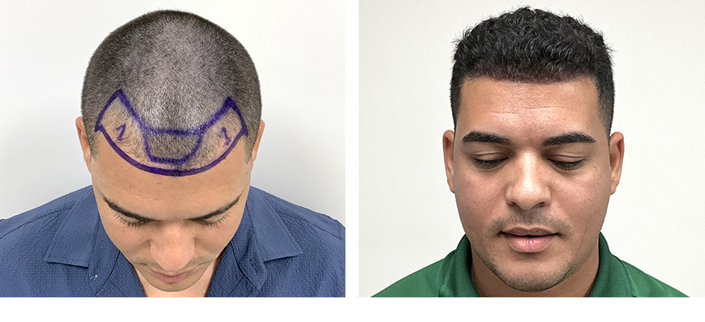 Hair Transplant Before and After in Miami