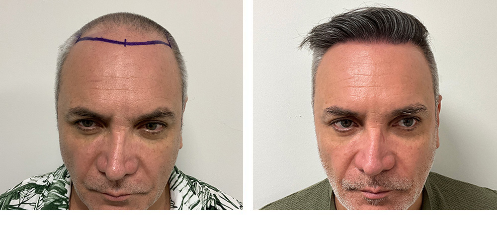 Hair Restoration Results Before and After
