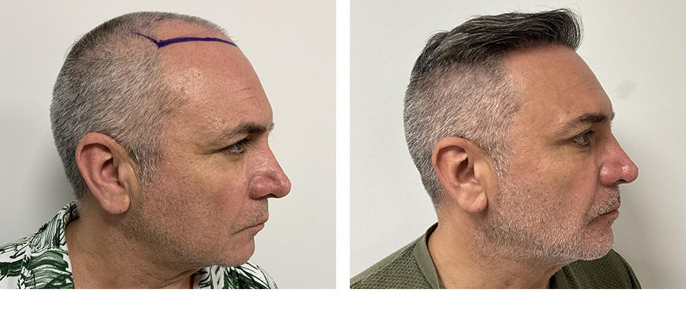 Hair Restoration Results Before and After