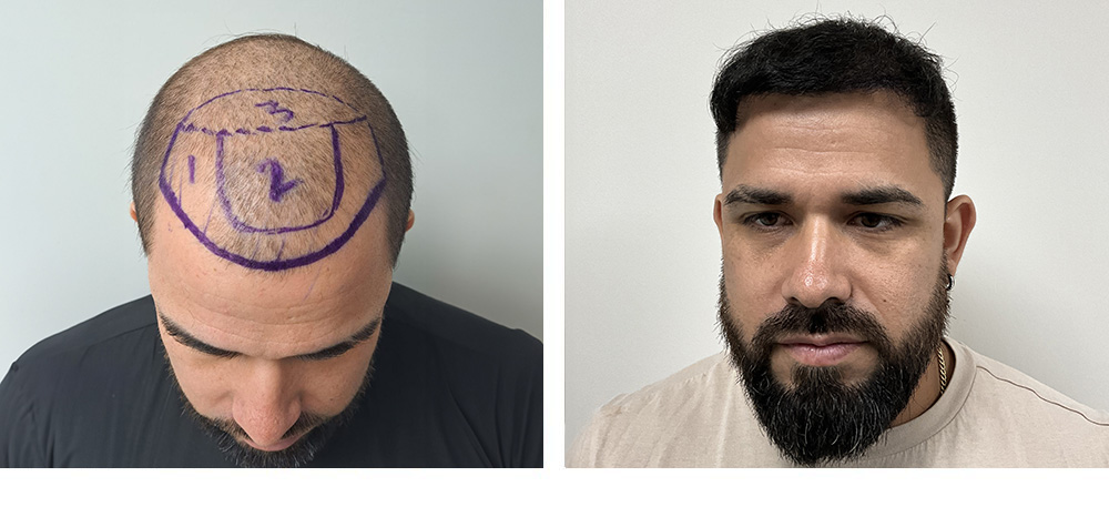 Hair Restoration Before and After