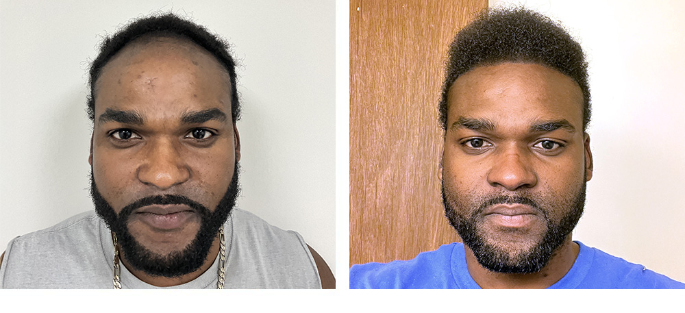 Hair Transplant Before and After