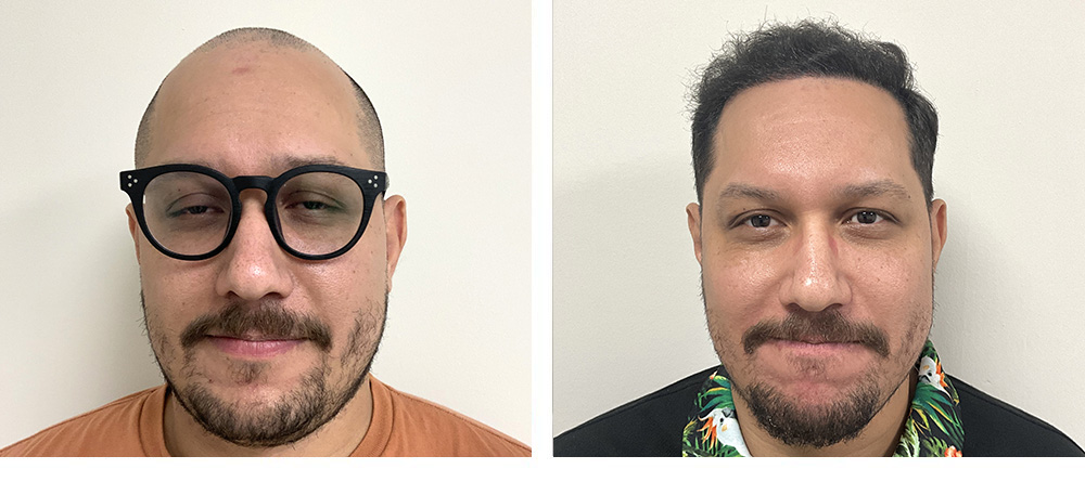 Hair Transplant before and after in miami