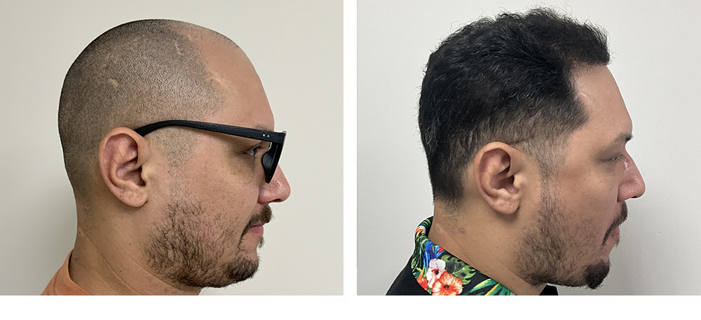 Hair Transplant before and after in miami