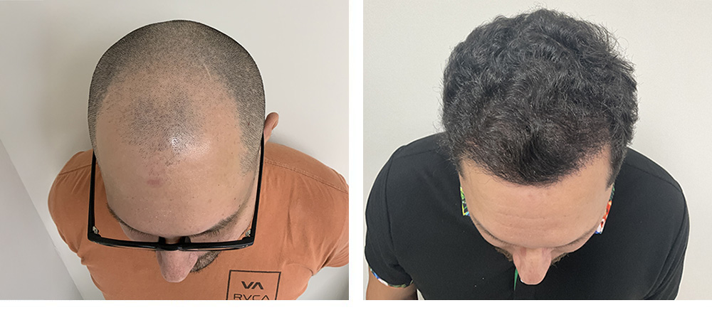 Hair Transplant before and after in miami