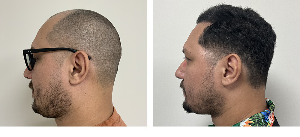 Hair Transplant before and after in miami