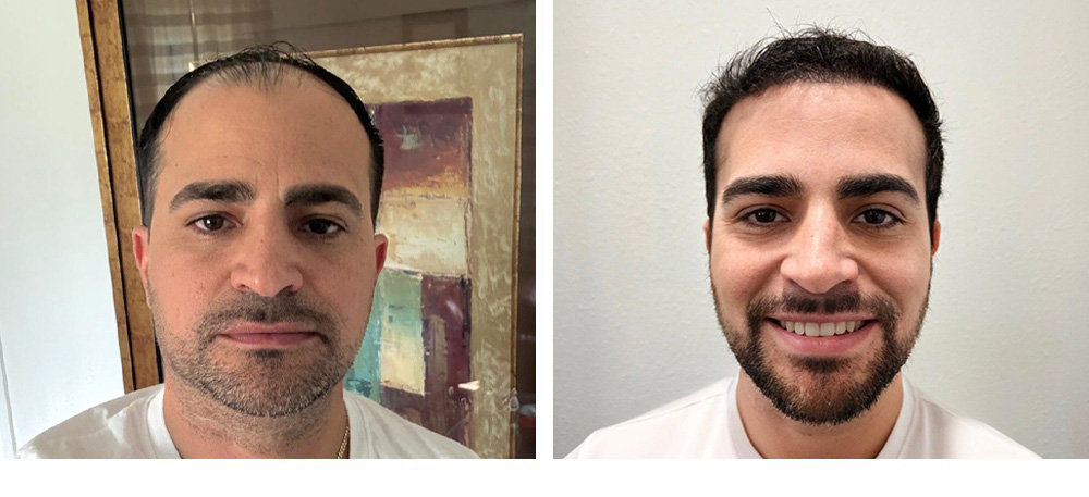 Hair Transplant Before and After