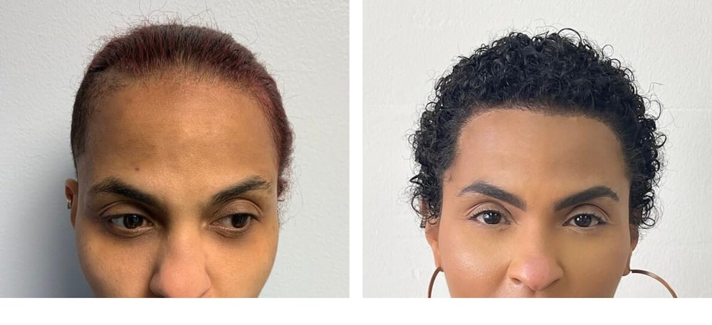 Hair Restoration Results Before and After