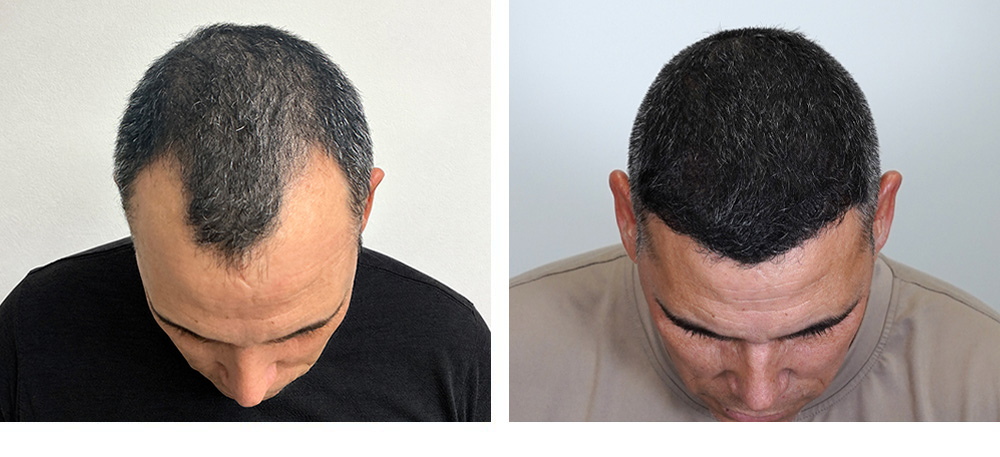 hair transplant before and after