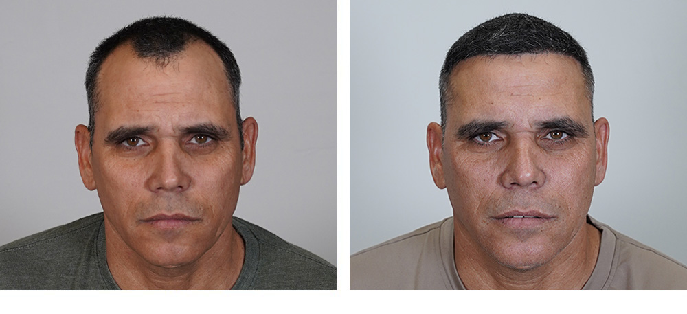 hair transplant before and after