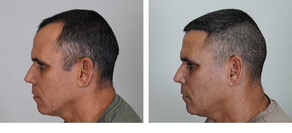 hair transplant before and after