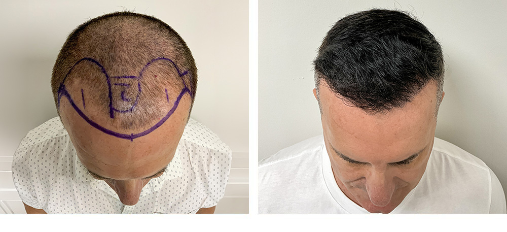 Hair Transplant Before and After in Miami