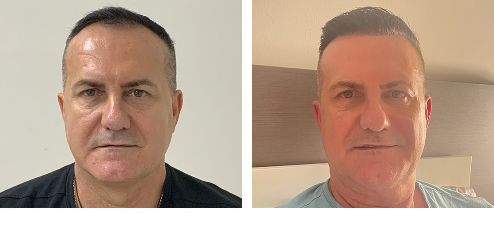 Hair Transplant Before and After in Miami