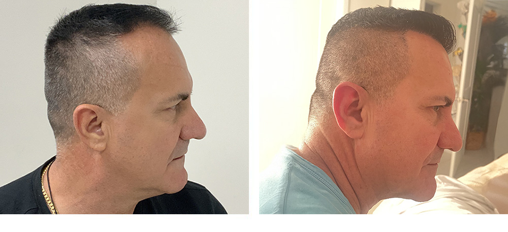 Hair Transplant Before and After in Miami