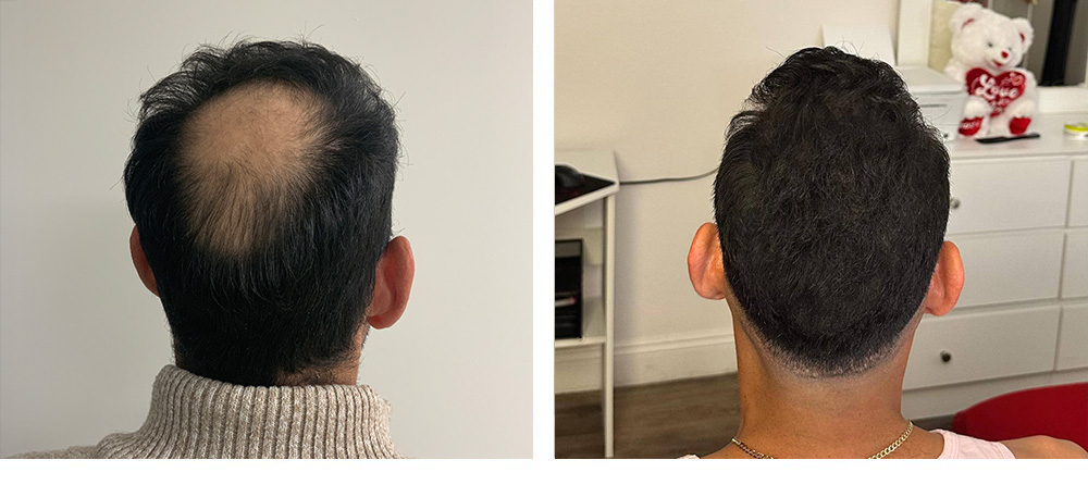 Hair Transplant Before and After in Miami
