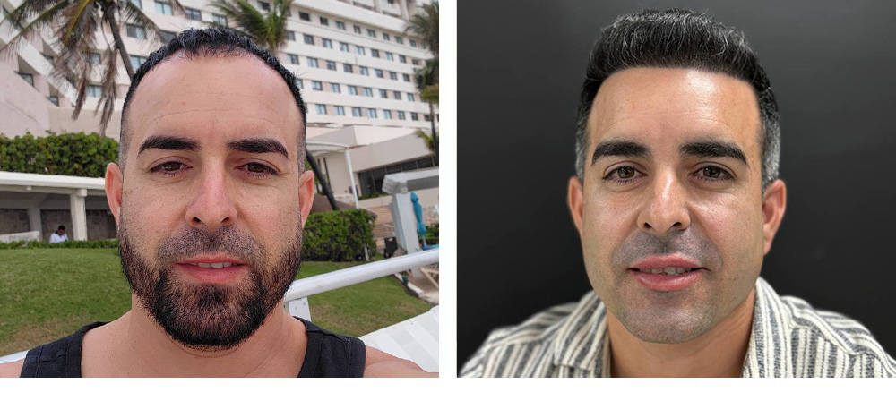 Hair Transplant Before and After