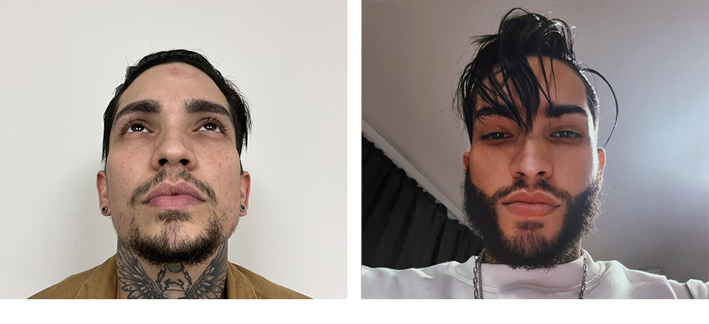 Beard hair transplant Before and After