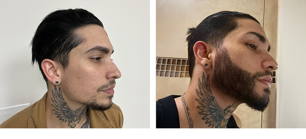 Beard hair transplant Before and After